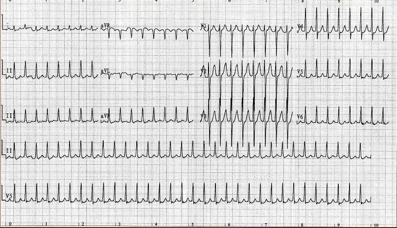 一患者突发心动过速，心电图如图所示，对于诊断该心动过速最有意义的是()