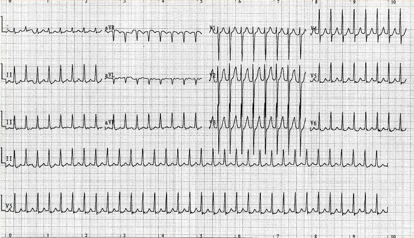 一患者突发心动过速，心电图如图所示，下列哪项不符合该心电图诊断的临床表现()