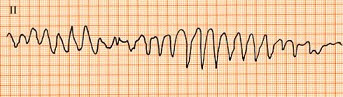 一心房颤动患者，应用奎尼丁复律，用药后第2天突发晕厥、心跳停止。心电图如图所示，诊断为()