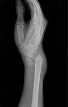 病历摘要：colles骨折患者男，21岁，摔倒撞地后右腕畸形，活动障碍两小时。查体：右手呈“枪刺手”