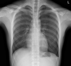病历摘要：气胸患者，男性，19岁，突发左胸痛2小时入院。查体.左侧呼吸音减低，深呼吸疼痛加剧，未闻及