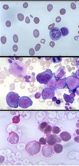 某贫血患者的血涂片、骨髓涂片、PAS染色分别如图所示，下列说法正确的是()
