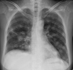肺转移瘤患者，女性，57岁。高热1小时，伴寒战、呼吸困难。有乙状结肠癌病史。查体：双肺呼吸音粗，未闻