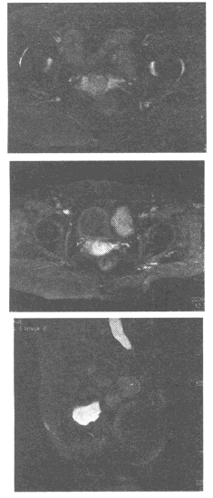 女，47岁，接触性阴道出血约2个月，MR检查如图女，40岁，乳腺MRI平扫见左侧乳腺类圆形明显长T2