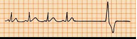 这是一名患者的心电图，心电图诊断考虑为()