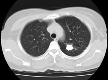 病历摘要：肺结核患者，女性，51岁。体检发现左上肺高密度结节。查体：双肺呼吸音清，未闻及干湿性啰音。