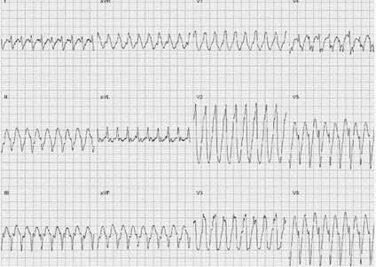心电图如下。患者目前心律失常的诊断是（）