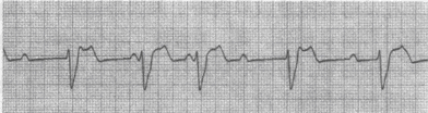 下图为患者使用阿托品后的心电图，考虑诊断为（）