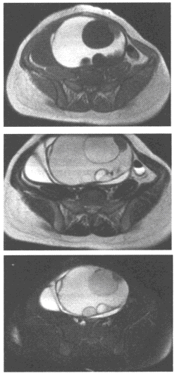 患者，女性，45岁，下腹部包块3个月余，盆腔MRI图像如下关于本病的描述，错误的是（）？A. 生长缓