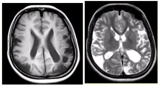 女性，22岁。癫痫发作及智力异常。MRI显示见下图。有关该病的描述正确的是（提示MRA所示如图。）（