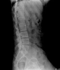 病历摘要：强直性脊柱炎患者男，36岁，腰痛10余年。查体.腰椎旁广泛压痛。行腰椎正侧位片检查。3、鉴