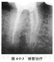 患者，男，67岁，退休。	主诉：左下后牙充填物松动1个月。	现病史：1个月前左下后牙充填物松动，随之