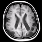 女性，22岁。癫痫发作及智力异常。MRI显示见下图。有关该病的描述，正确的是（）