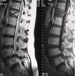 患者男，70岁，因肝癌入院，准备行肝移植手术。住院期间因腰扭伤而腰痛，故行腰椎MRI检查（如下图）。