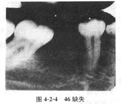 患者，女，42岁，教师。	主诉：左上后牙遇甜食及冷热酸痛1个月。	现病史：1个月前吃甜食感到左上后牙