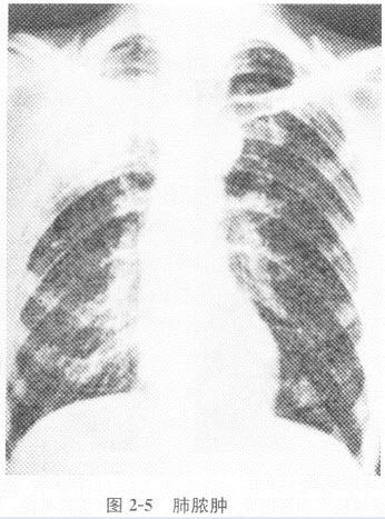 根据下图，请简述肺脓肿及其X线表现。	