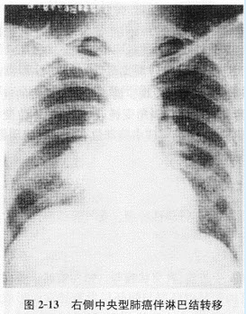根据下图，请简述肺占位性病变分为哪几种及其X线表现					