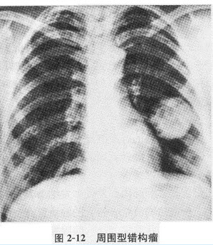 根据下图，请简述肺占位性病变分为哪几种及其X线表现					