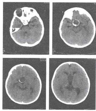 患儿，男，5岁，CT平扫图像如下，最可能的诊断是（）