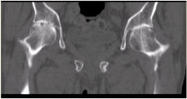 患者女，53岁，双髋关节痛。双髋关节CT平扫冠状重组影像如下图。	对定性诊断有价值的征像包括（）A.