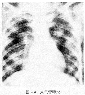 根据下图，请简述支气管肺炎及其X线表现。	