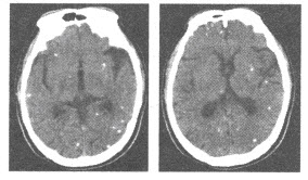 成年男性，癫痫，颅脑CT平扫图像如下，最可能的诊断为（）