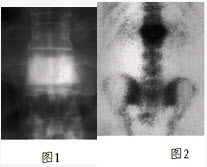 椎体X线片显示T10椎体呈骨硬化改变，即“象牙椎”，应鉴别诊断的疾病不包括（）