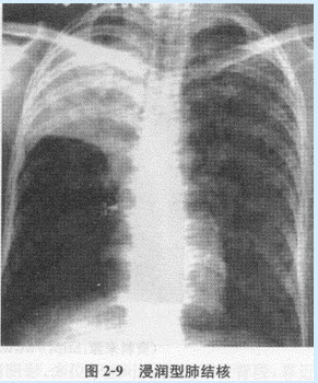根据下图，请简述我国肺结核的五大分类及其X线表现。					