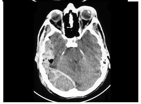 男，29岁，头颅外伤，结合CT图像，最可能的诊断是（）