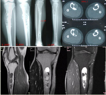 患者女，20岁，右小腿疼痛1周。行双小腿正侧位CR，并行双小腿CT及MR扫描，见下图。对于此病变的征