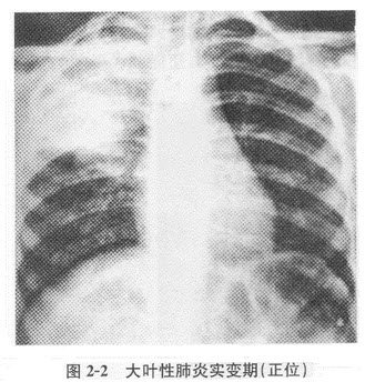 根据下图，请简述大叶性肺炎及其X线表现		