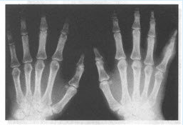 双手X线平片见下图，类风湿因子阳性，抗“O”轻度增高，血沉为25mm/h。该病最可能的诊断是（）