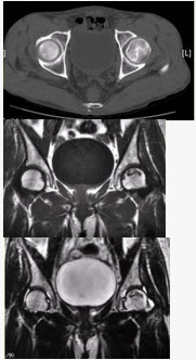 患者男，47岁，左髋部疼痛及压痛6个月，“4”字试验阳性。左髋关节内、外旋活动受限。检查提示：左髋关