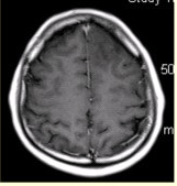 患者男，37岁。癫痫发作数次。MRI显示如下图。[图][图][图...	患者男，37岁。癫痫发作数次