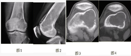 根据膝关节CR和CT影像，你认为此病例的影像学表现有（）