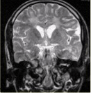 男性，16岁，头痛2年，加重1个月。MR检查如下图。可能的诊断是（）