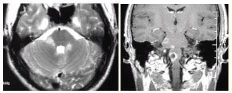 患者男，35岁，肢体无力半年。头部MRI显示如下图。[图]A....	患者男，35岁，肢体无力半年。