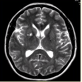 男性，55岁。临床偶尔头晕，无高血压，糖尿病病史。MRI显示如下图。可能的诊断是（）