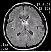 男性，55岁。临床偶尔头晕，无高血压，糖尿病病史。MRI显示如下图。可能的诊断是（）