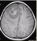 患者男，18岁，头痛15d伴复视10d，头部CT及MRI显示如下图。关于少枝胶质细胞瘤，描述错误的是