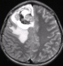 患者男，18岁，头痛15d伴复视10d，头部CT及MRI显示如下图。关于少枝胶质细胞瘤，描述错误的是