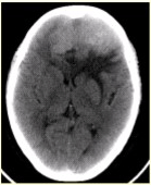 患者女，68岁。头痛、恶心2周，加重2d。头CT显示如下图。关于该病的描述，正确的是（）