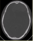 患者女，68岁。头痛、恶心2周，加重2d。头CT显示如下图。关于该病的描述，正确的是（）