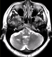 患者女，41岁。头痛半年，加重10d。头部MRI显示如下图。[图...	患者女，41岁。头痛半年，加
