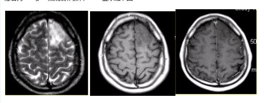 患者男，37岁。癫痫发作数次。MRI显示如下图。[图]A....	患者男，37岁。癫痫发作数次。MR