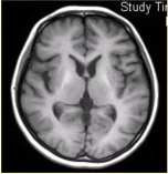 患者女，18岁，步态不稳。MRI显示如下图。进一步询问的病史应包括（）