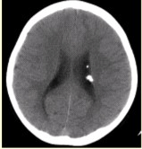 患者男，20岁，面部皮脂腺瘤，头CT显示如下图。该病伴有的相关异常不包括（）