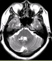 患者女，41岁。头痛半年，加重10d。头部MRI显示如下图。根据该病的影像学表现，该病可能的诊断是（
