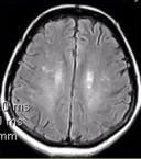患者女，48岁。渐进性肢体无力半年。MRI所示如下图。根据MRI表现，可能的诊断是（）