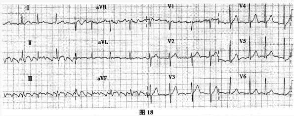 55岁女性，反复发作心悸来诊。心电图如图18。	典型心房扑动的发病机制是（）A. 心房自律性增强B.